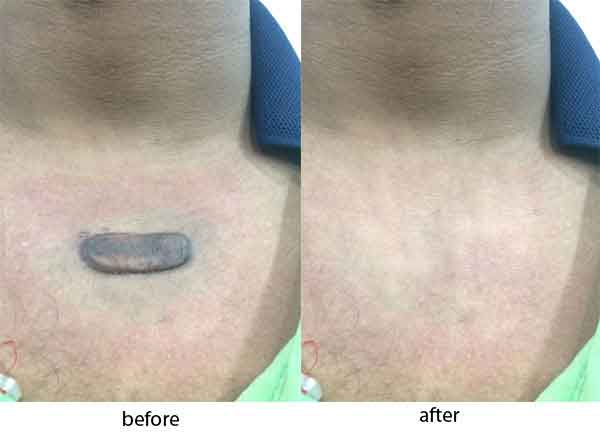 Keloid Removal Treatment Pune Cryotherapy And Flurouracil Bleomycin